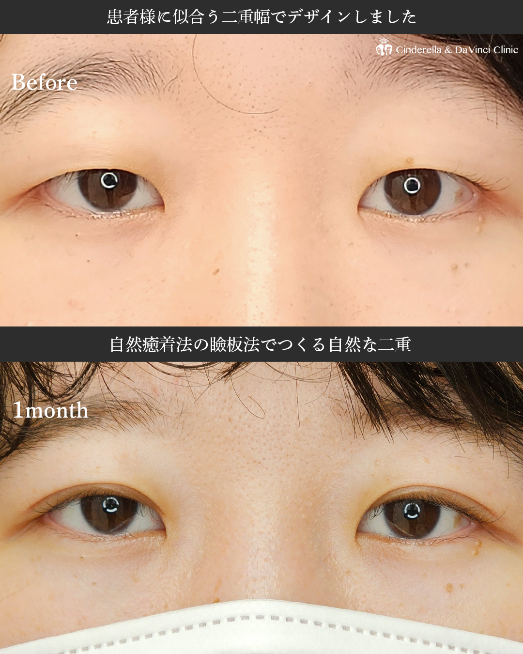 似合わせ二重の画像