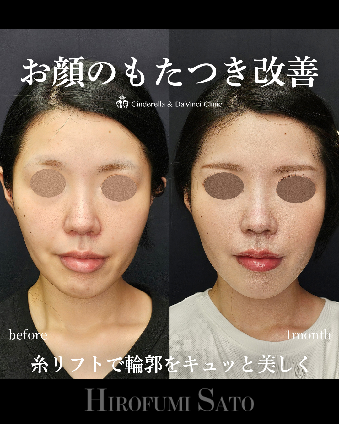 糸リフトでお顔のもたつき改善の画像