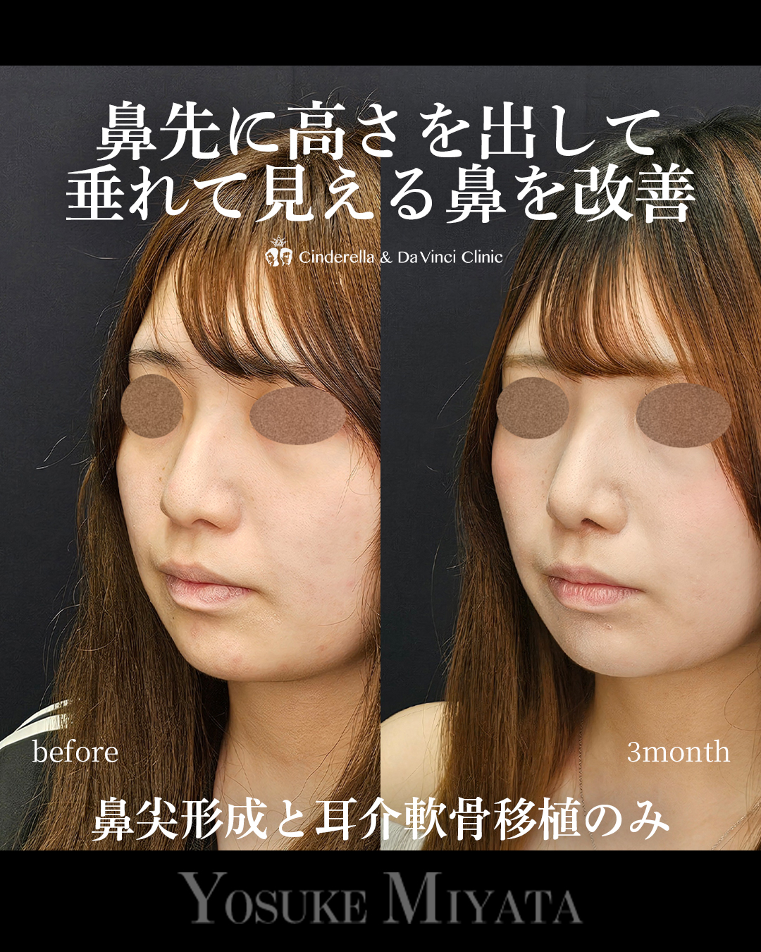 鼻先高く垂れ改善の画像