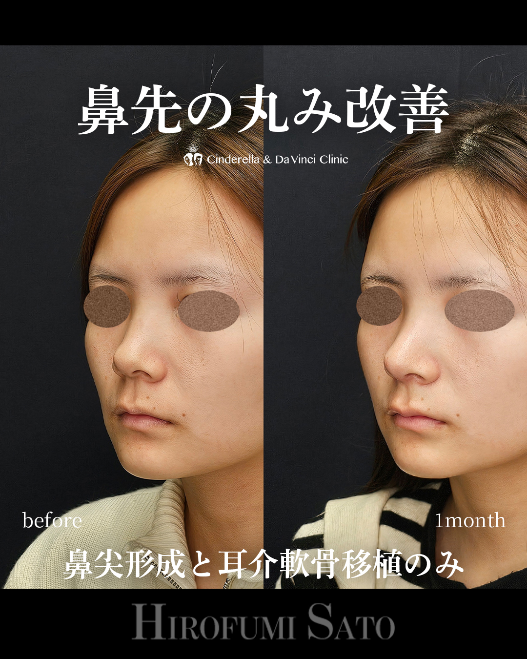 鼻先の丸み改善の画像