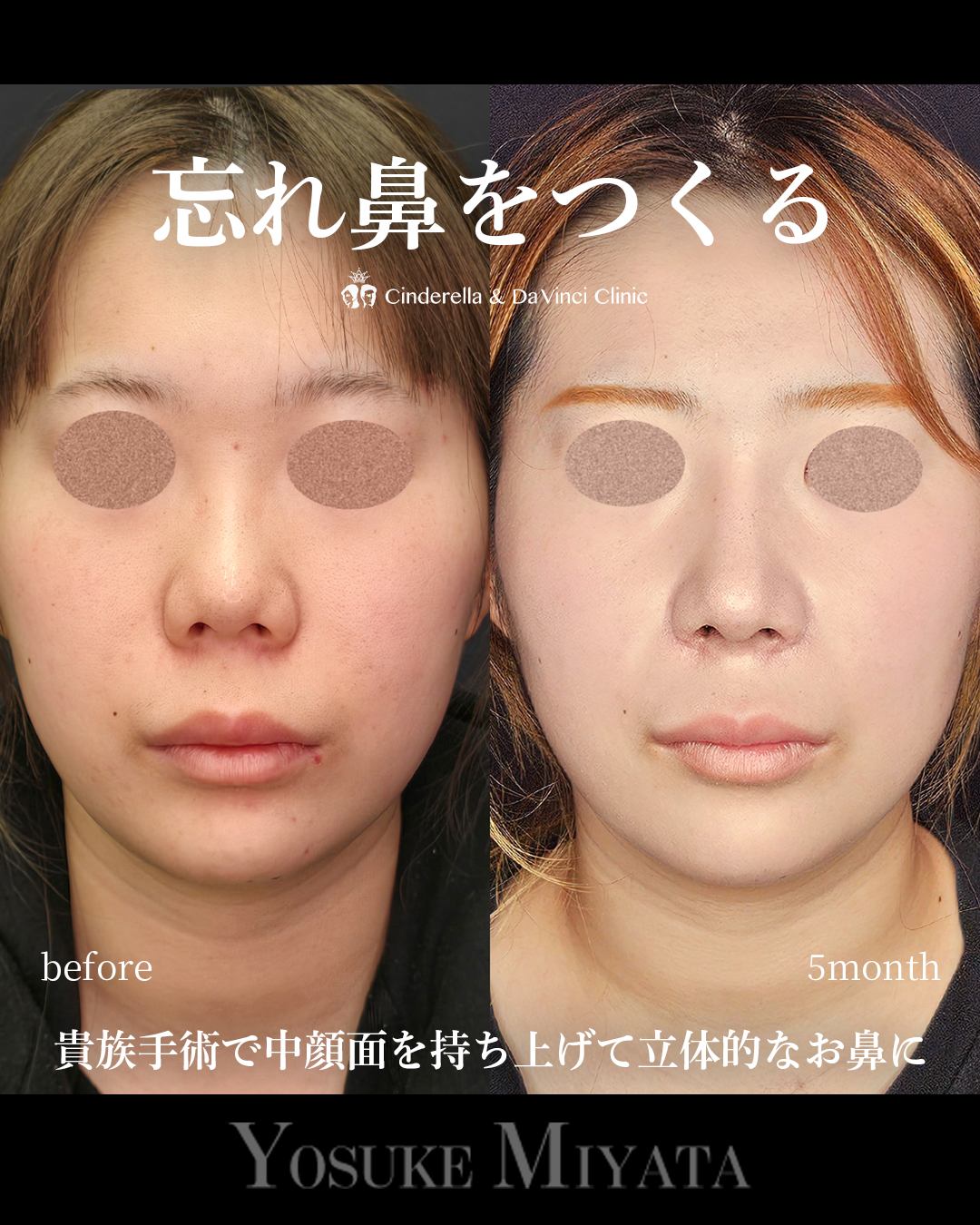 鼻整形で忘れ鼻にの画像