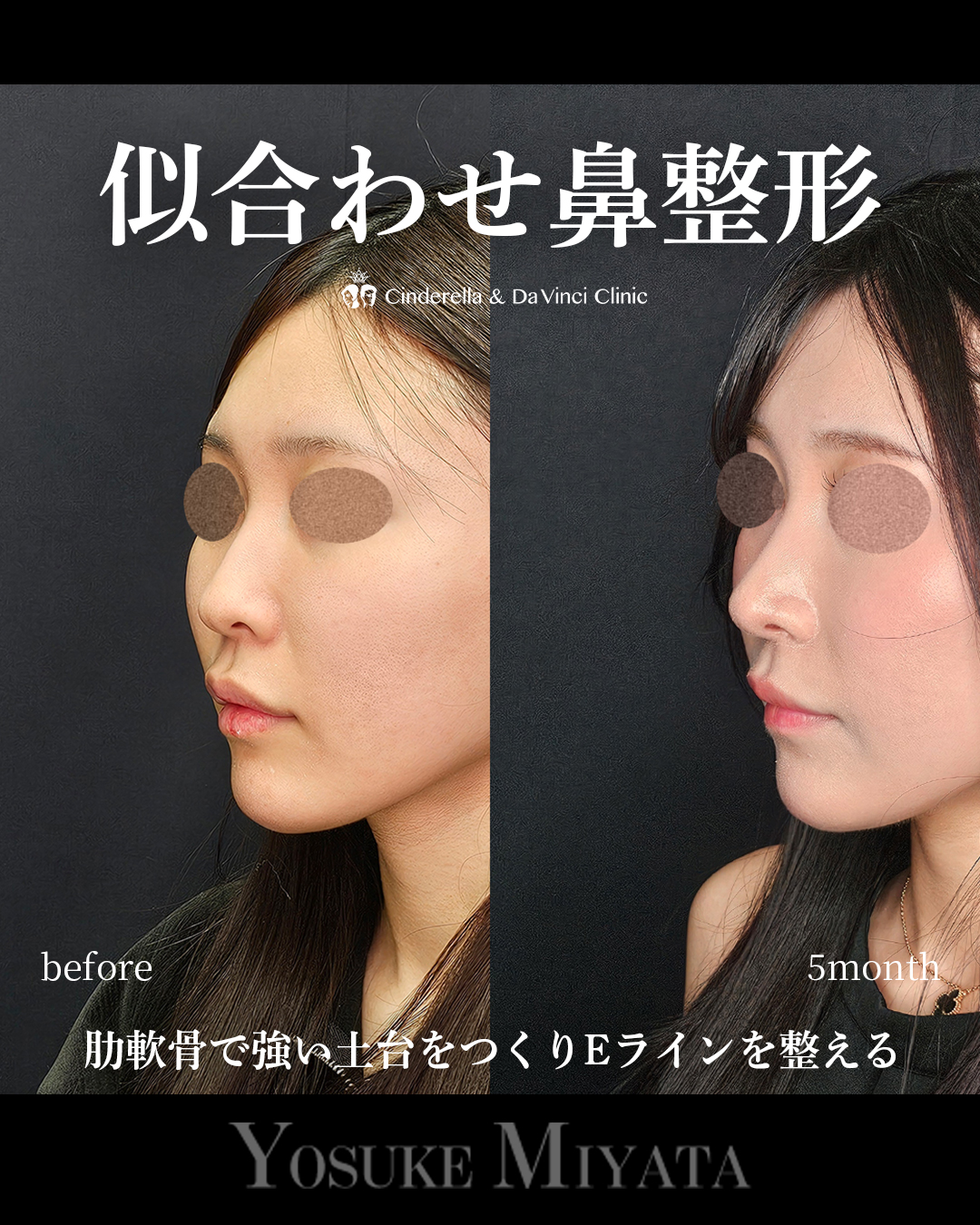 似合わせ鼻整形の画像