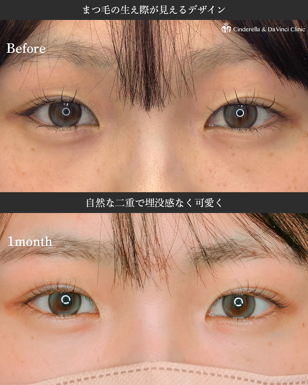 自然で可愛い二重の画像
