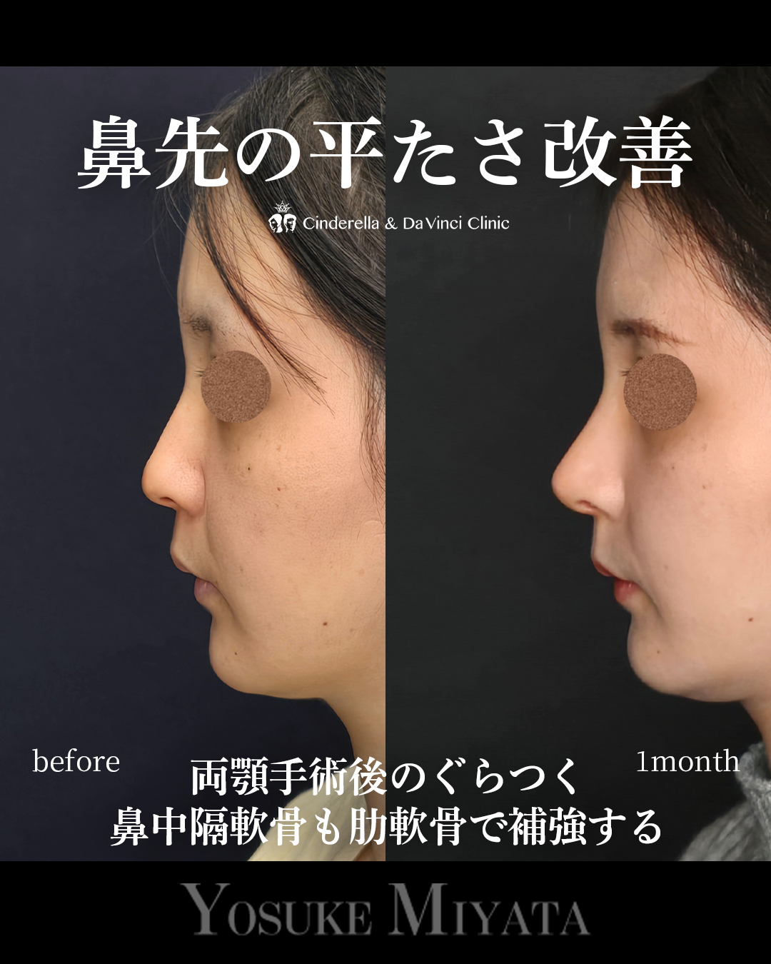 鼻先の平たさ改善の画像