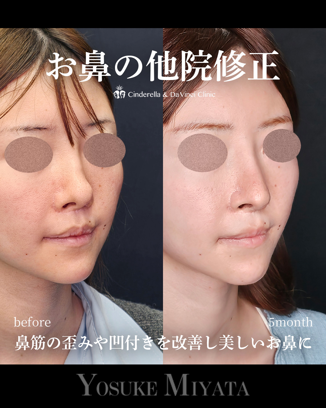 お鼻の他院修正の画像