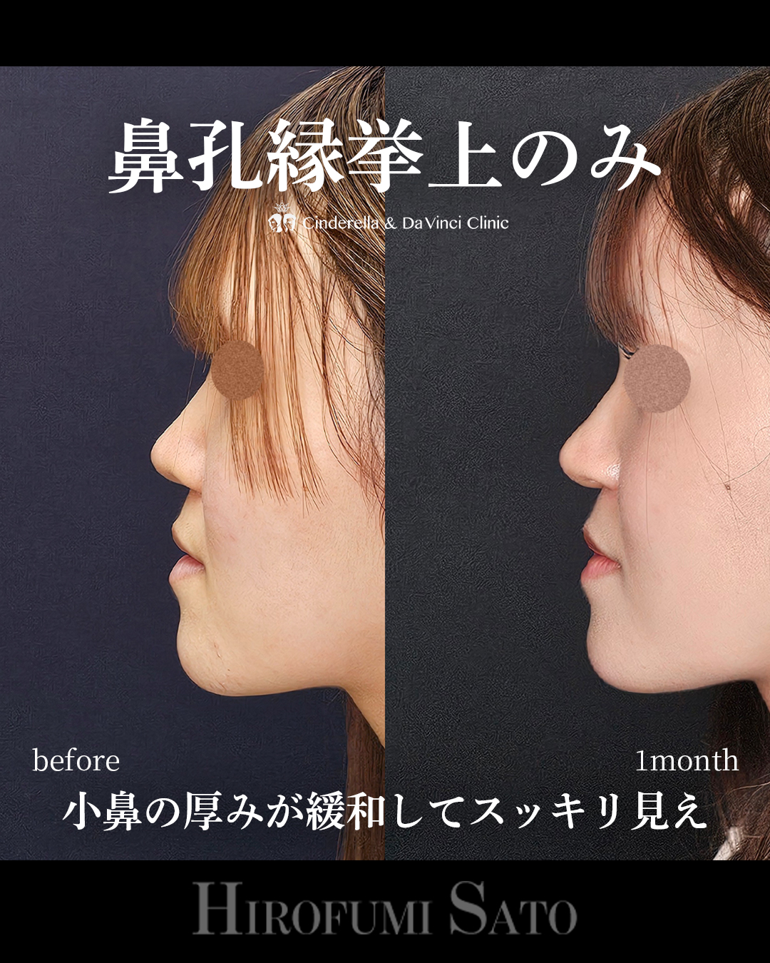 鼻孔縁挙上のみの画像