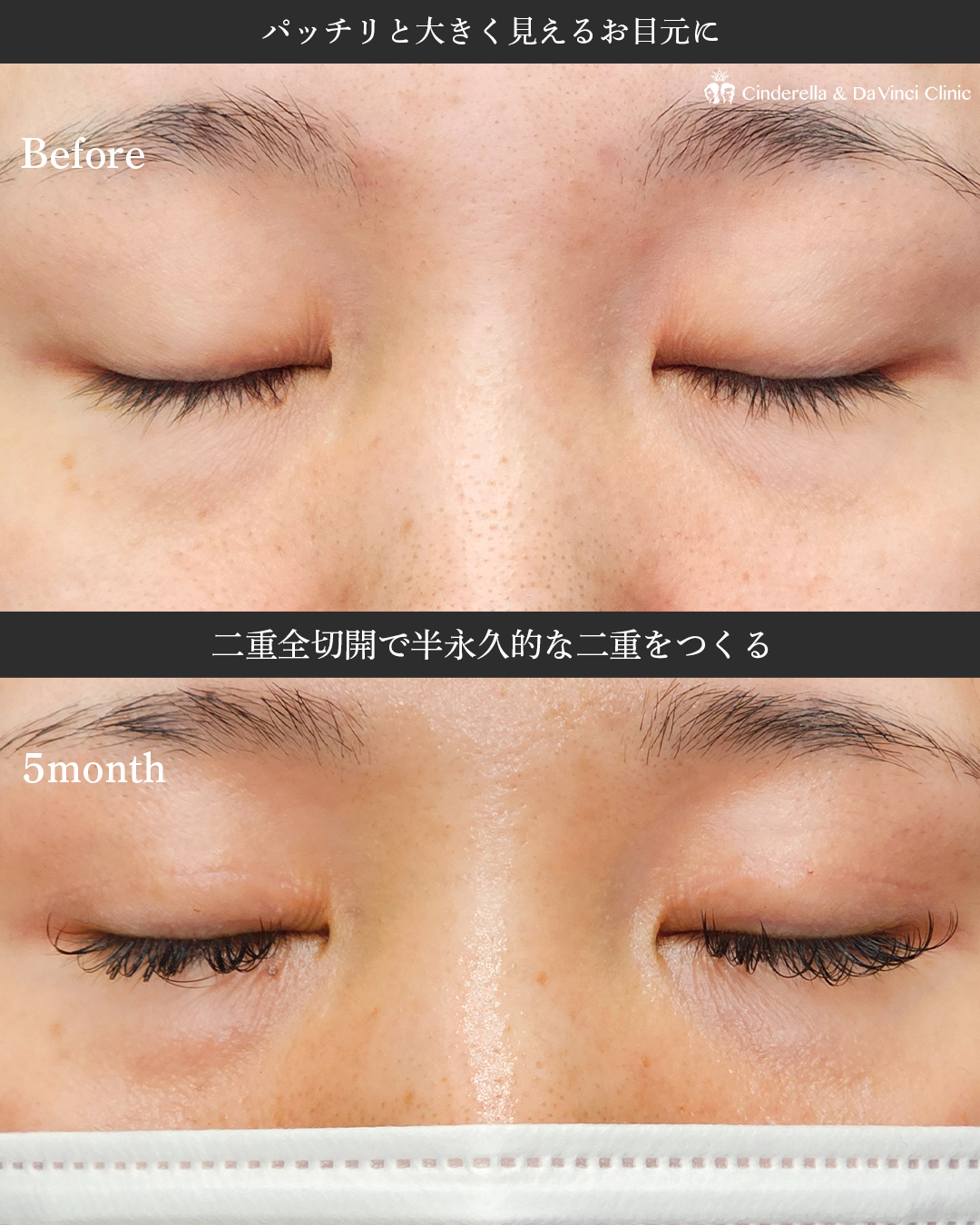 全切開で目元大きくの画像