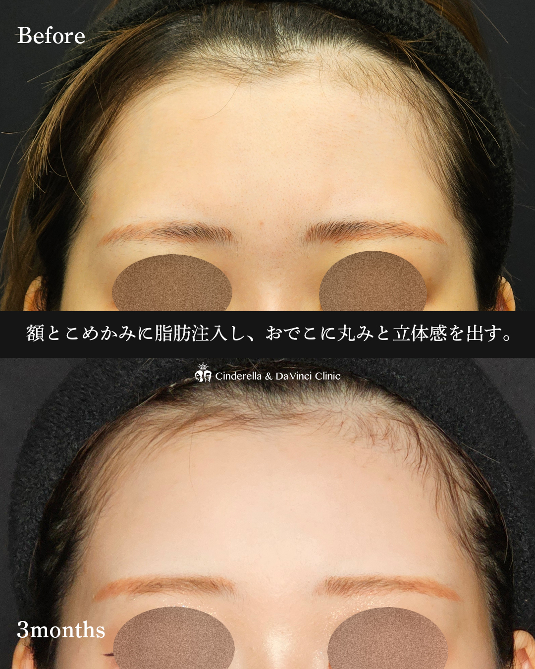 おでこの脂肪注入の画像
