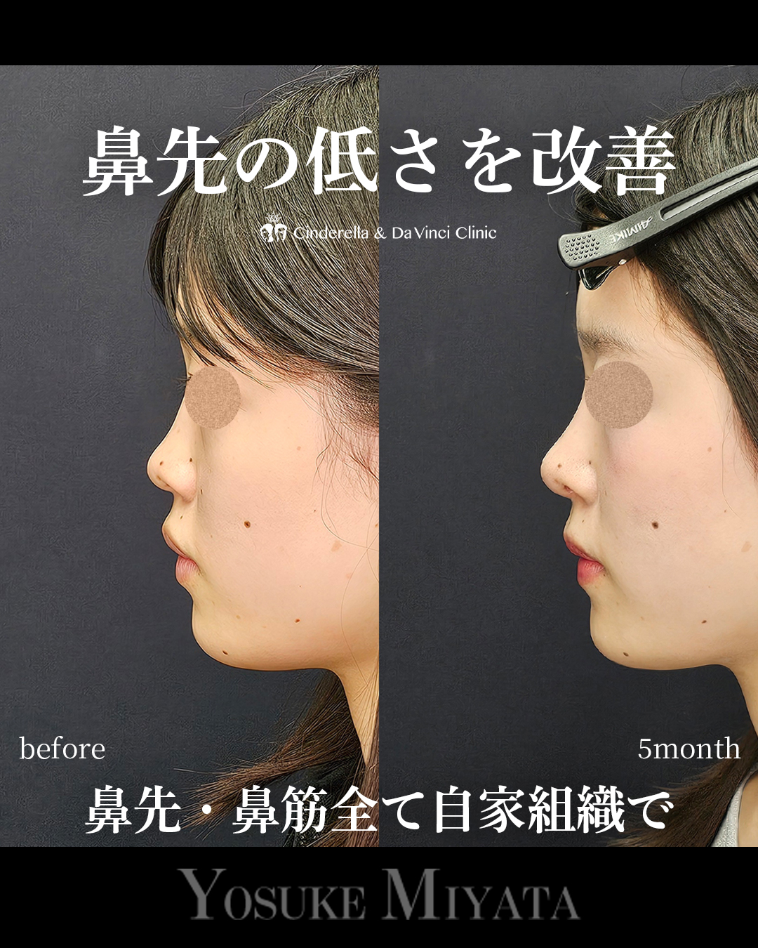 鼻先の低さ改善の画像