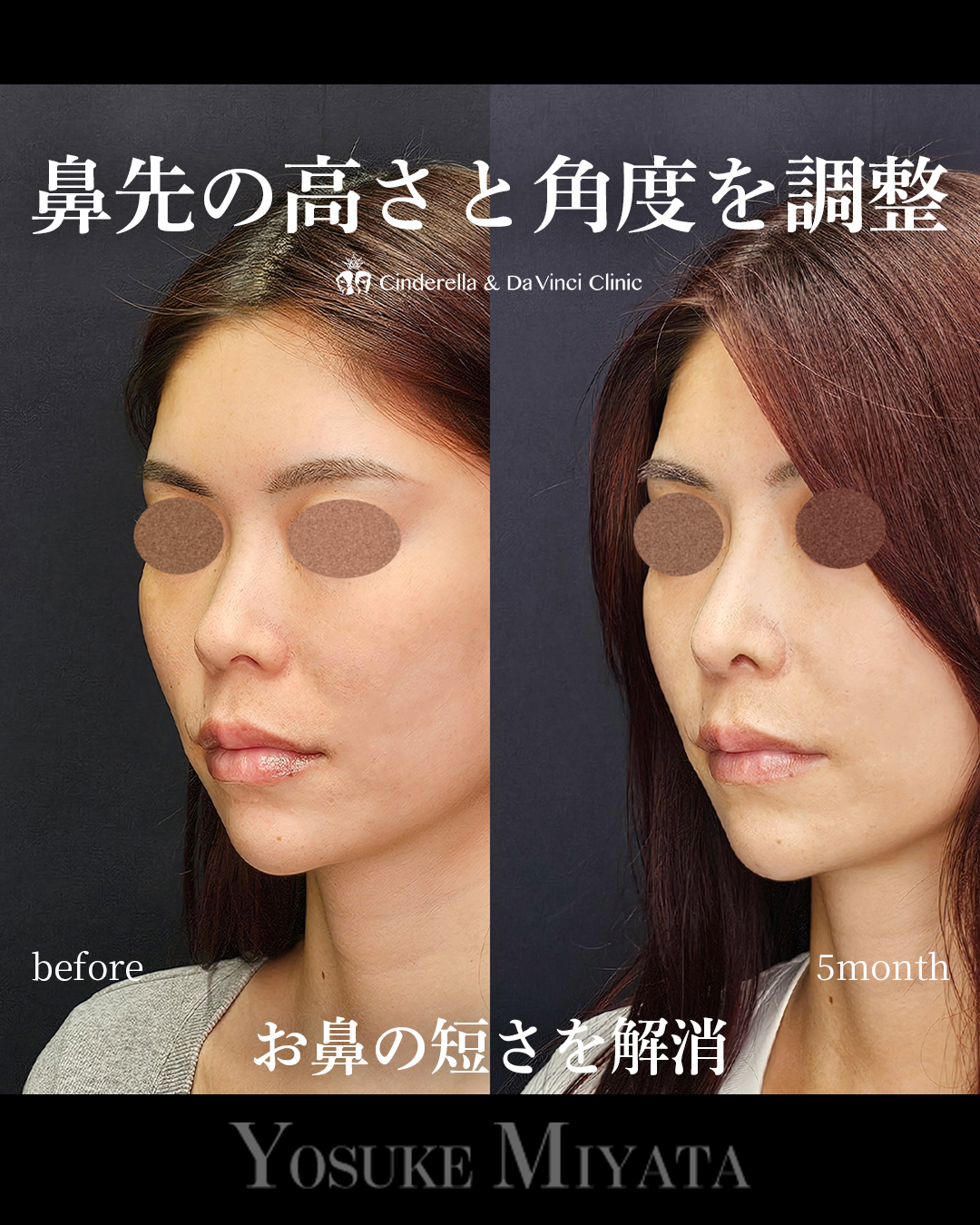 短い鼻を改善するの画像