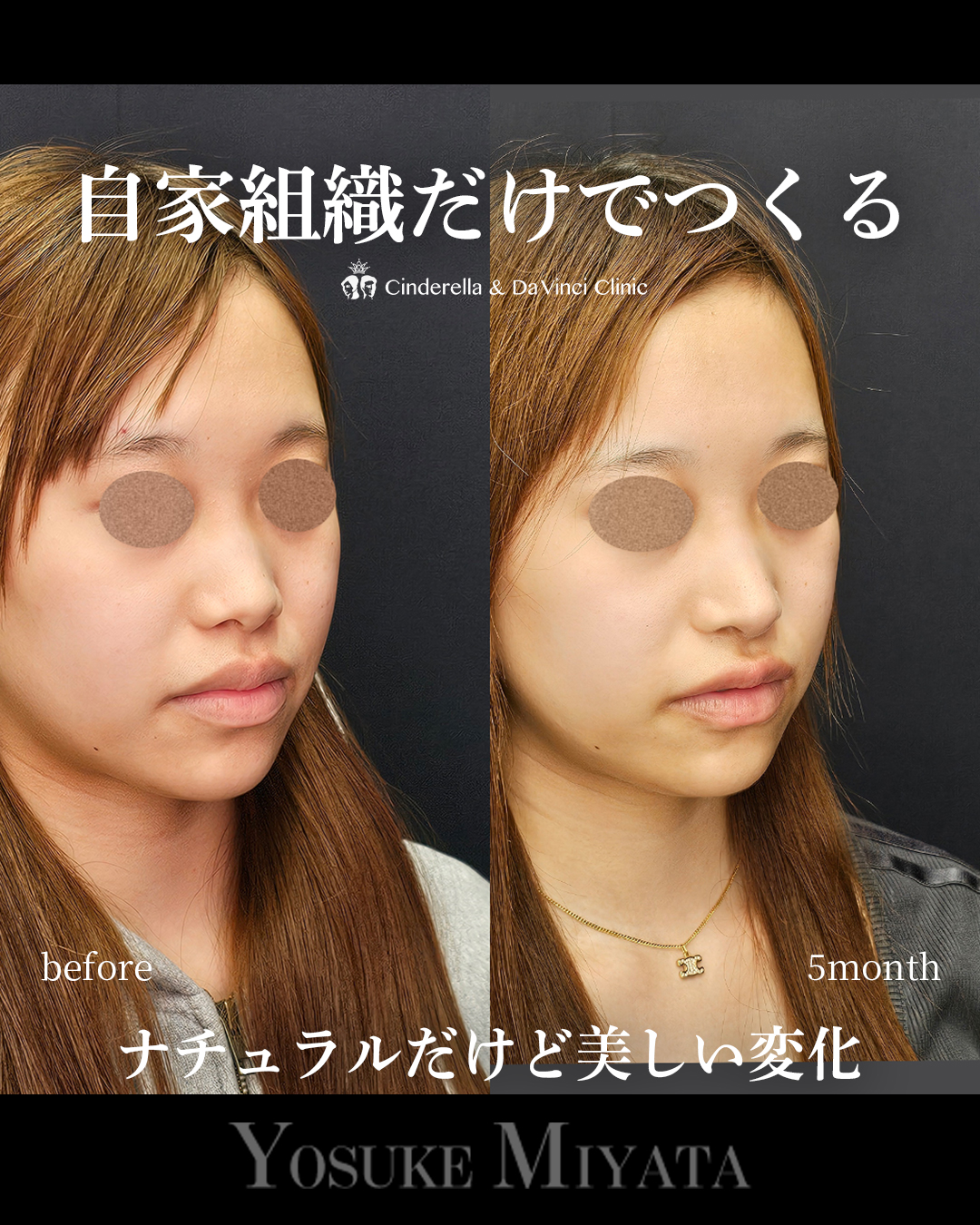 自家組織で鼻整形の画像