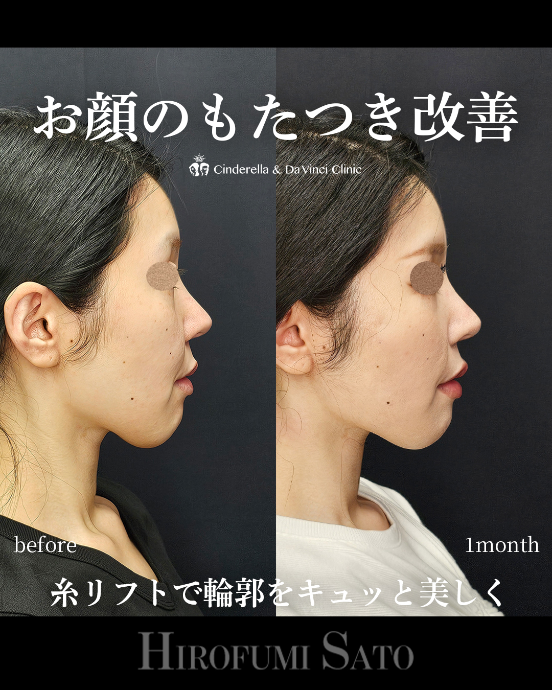 糸リフトでお顔のもたつき改善の画像