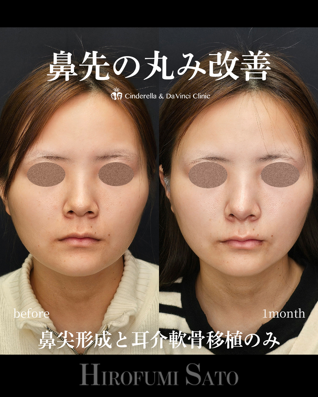 鼻先の丸み改善の画像
