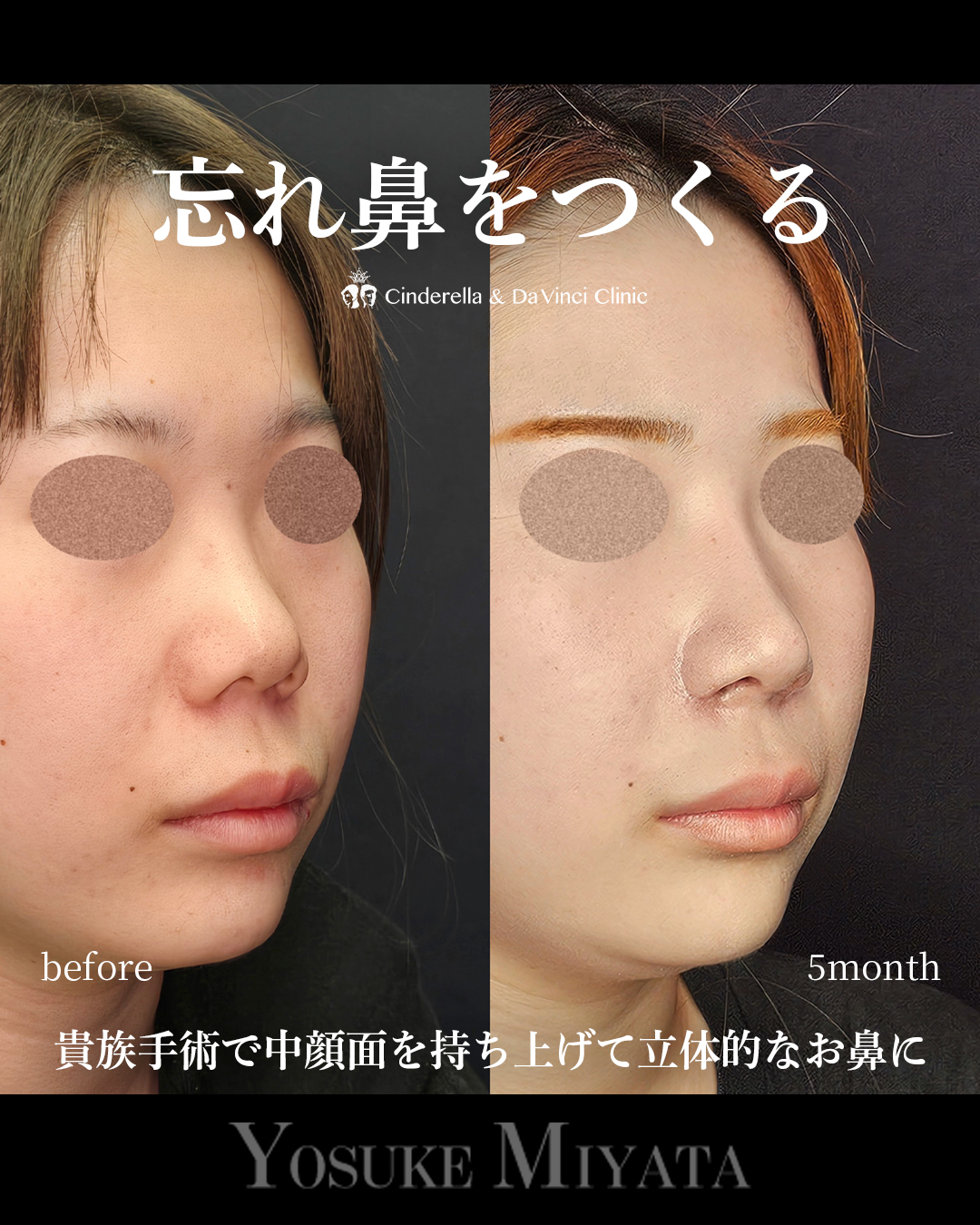 鼻整形で忘れ鼻にの画像