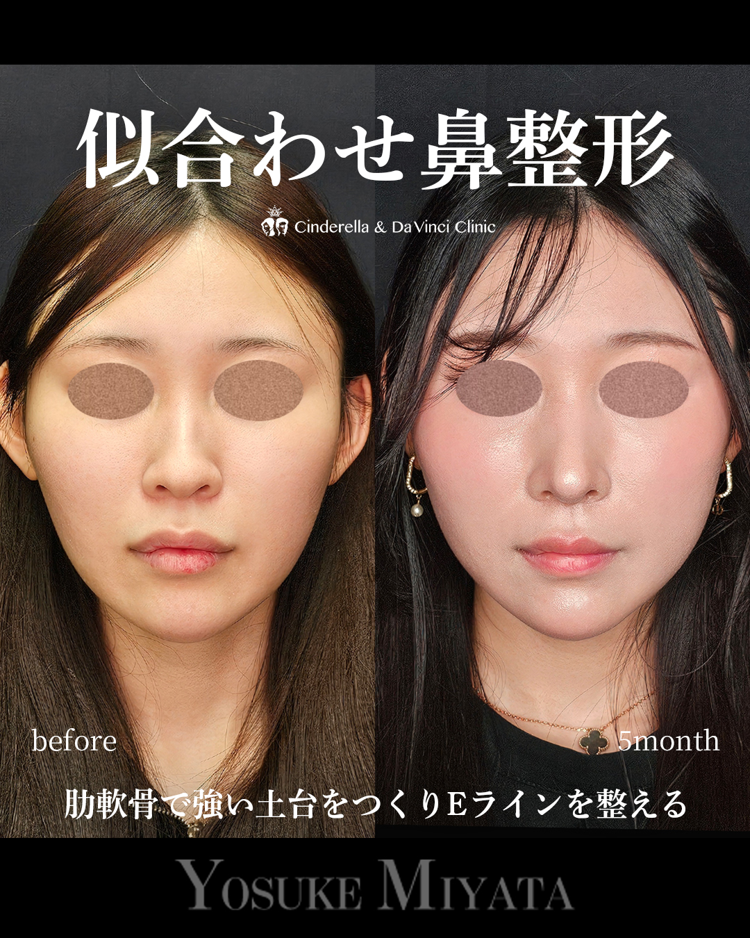 似合わせ鼻整形の画像