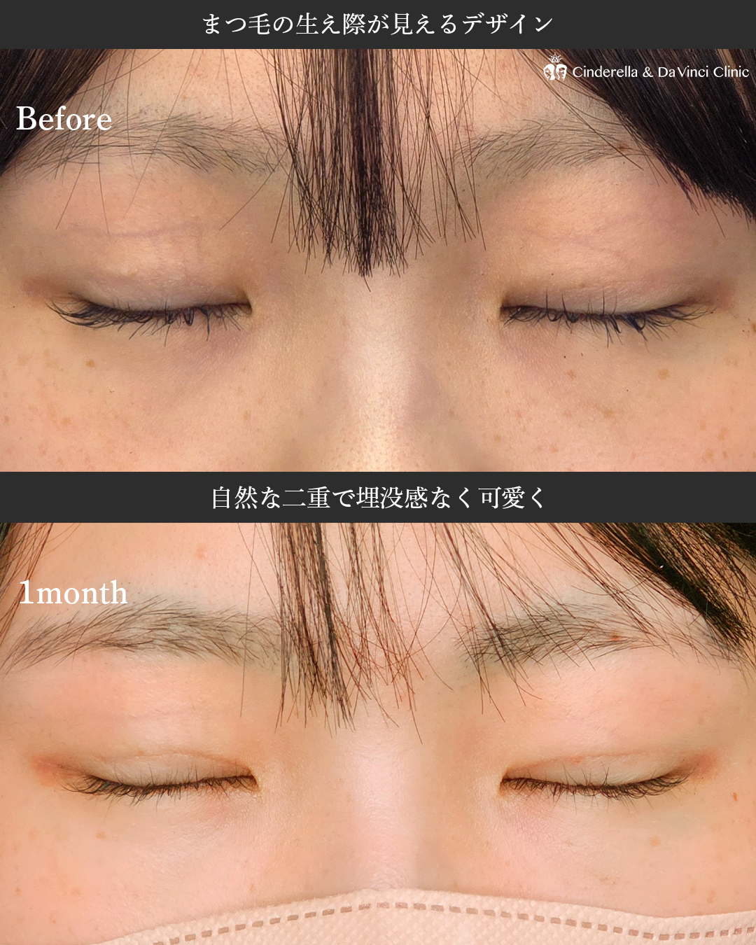 自然で可愛い二重の画像
