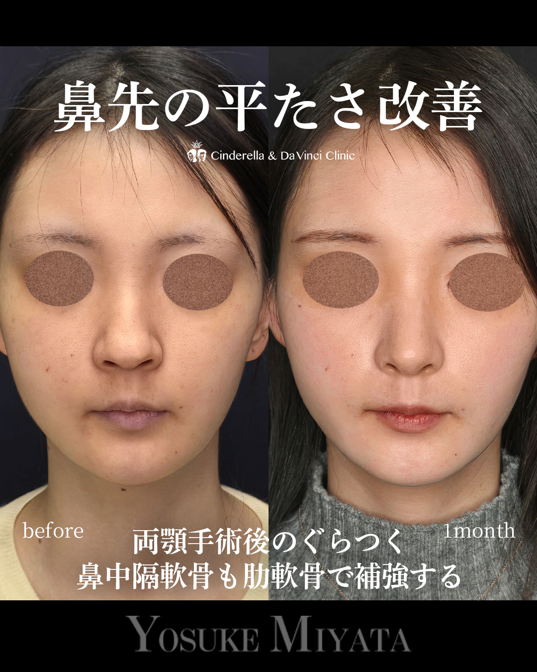鼻先の平たさ改善の画像