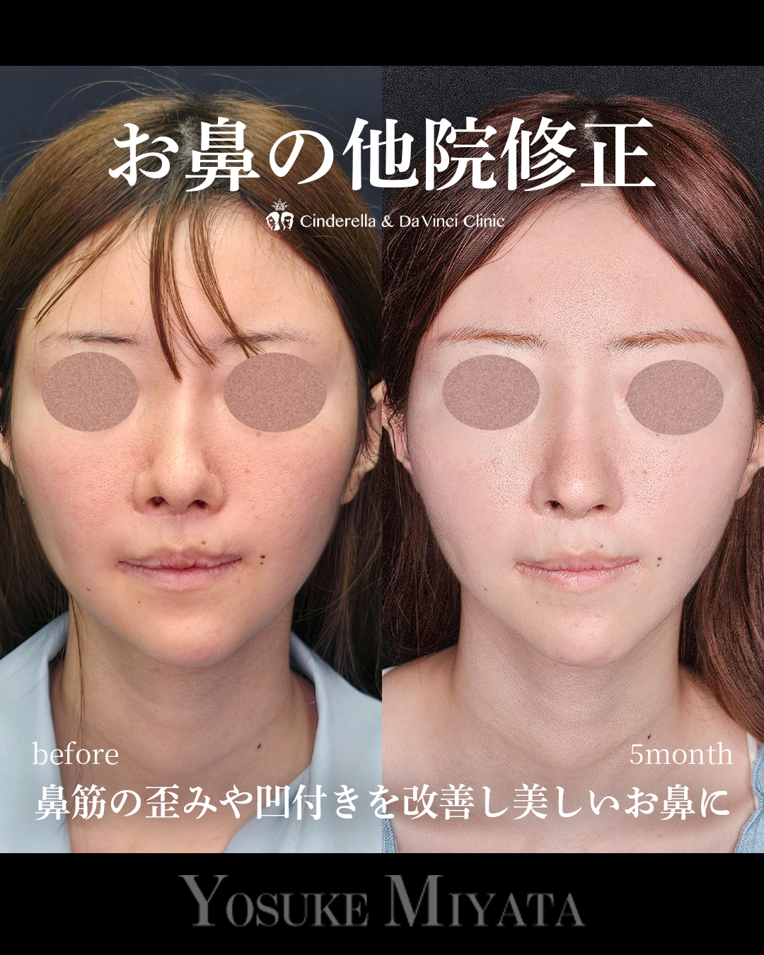 お鼻の他院修正の画像