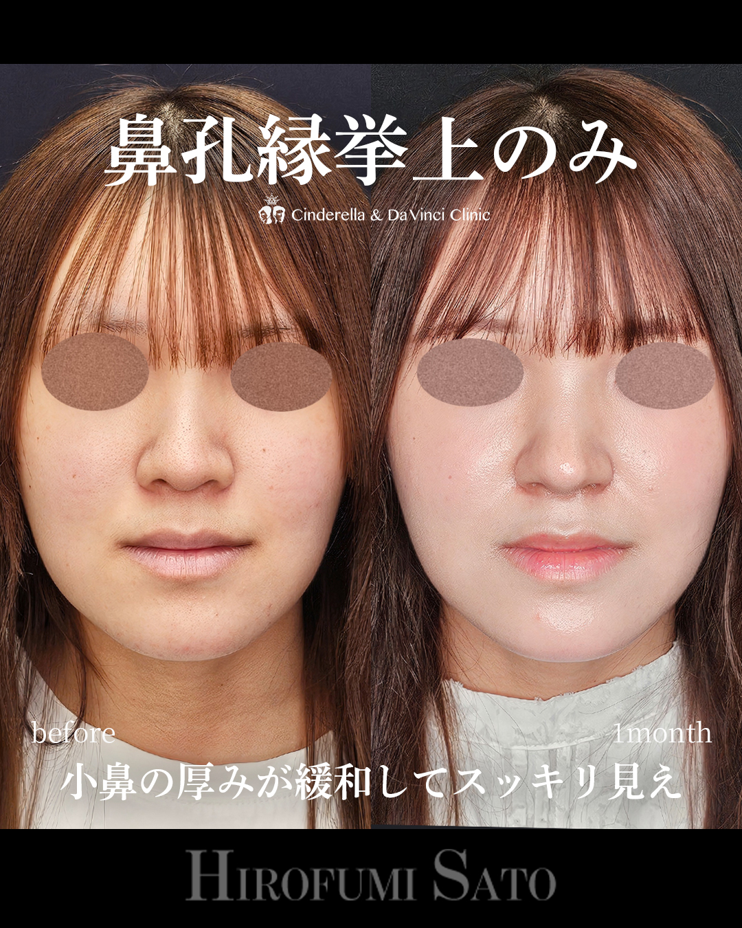 鼻孔縁挙上のみの画像