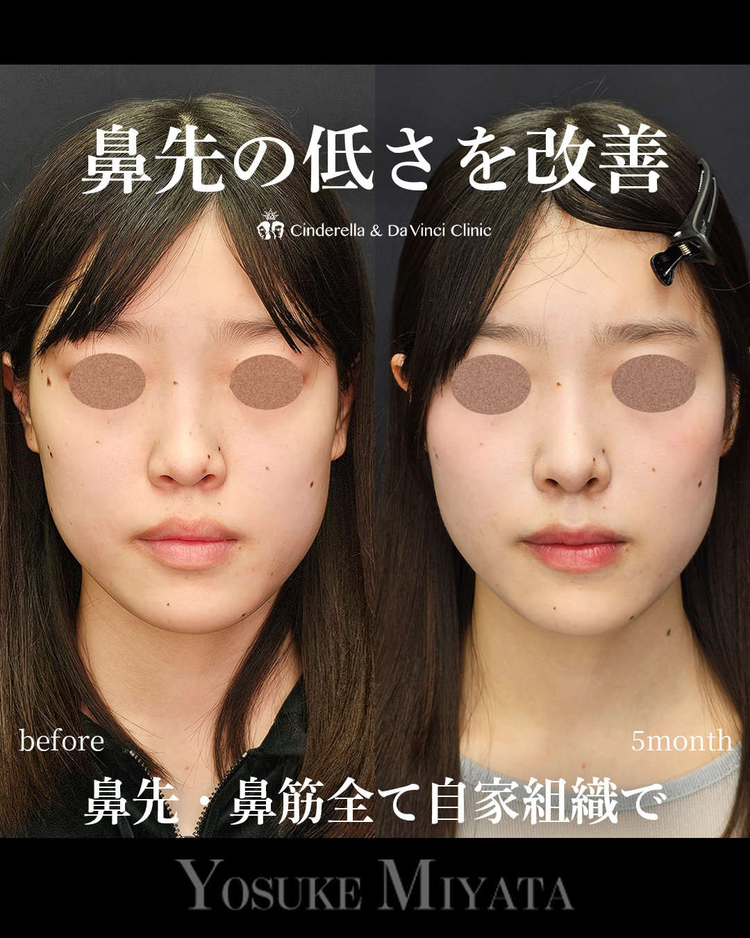 鼻先の低さ改善の画像