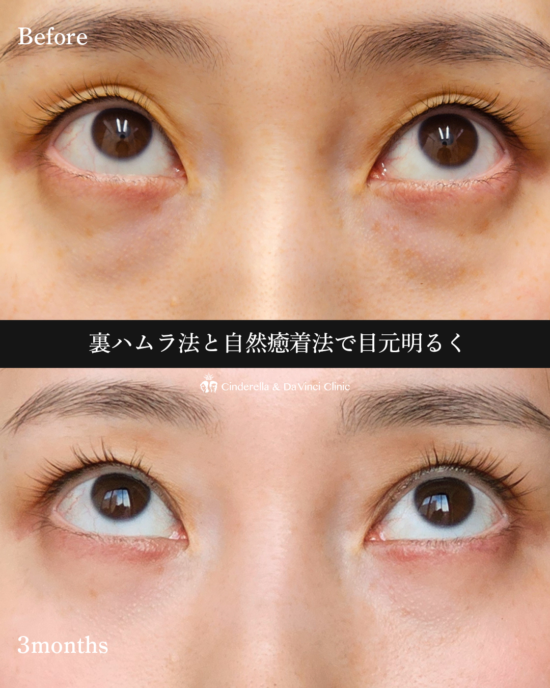 クマ取りと二重整形の画像