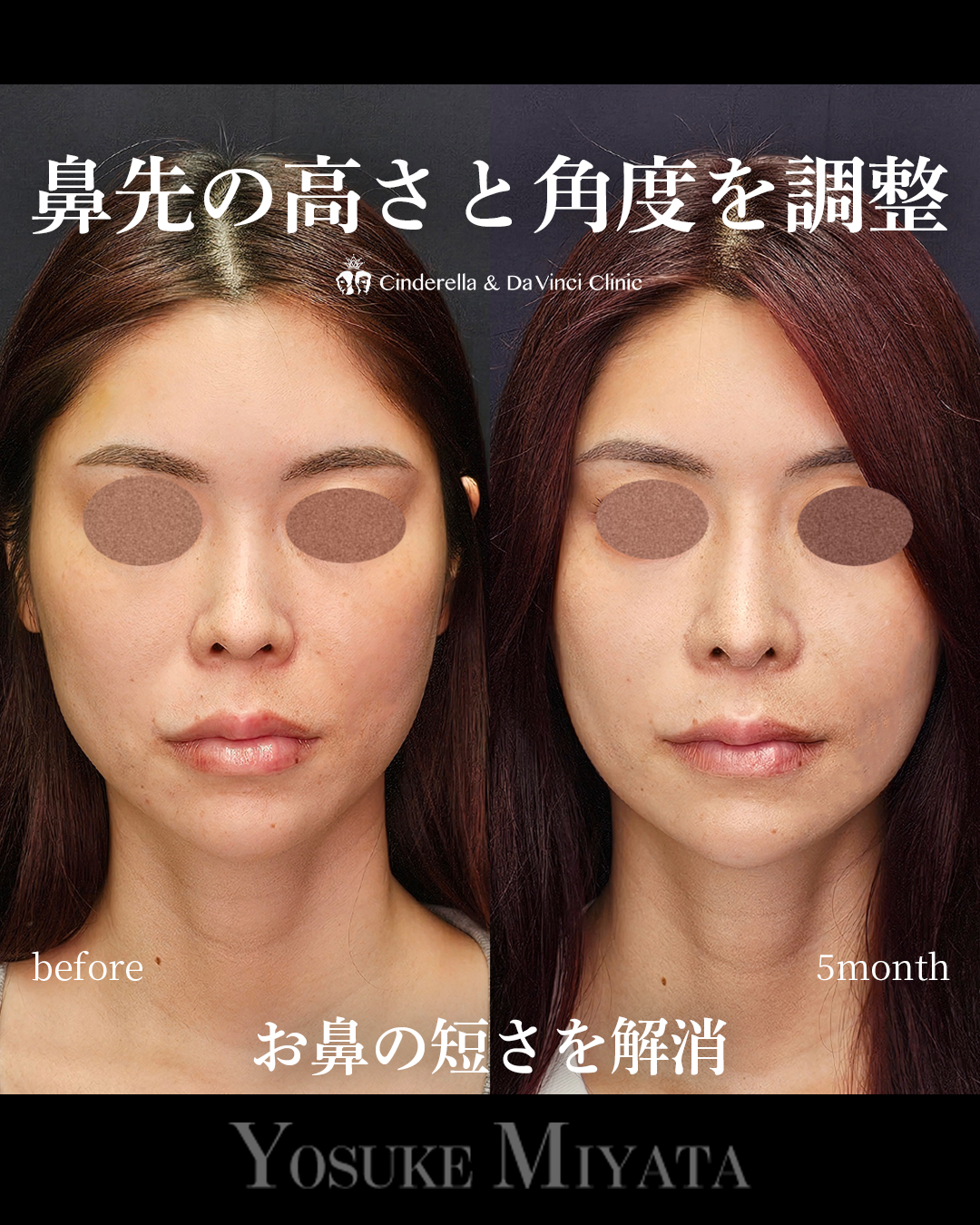 短い鼻を改善するの画像
