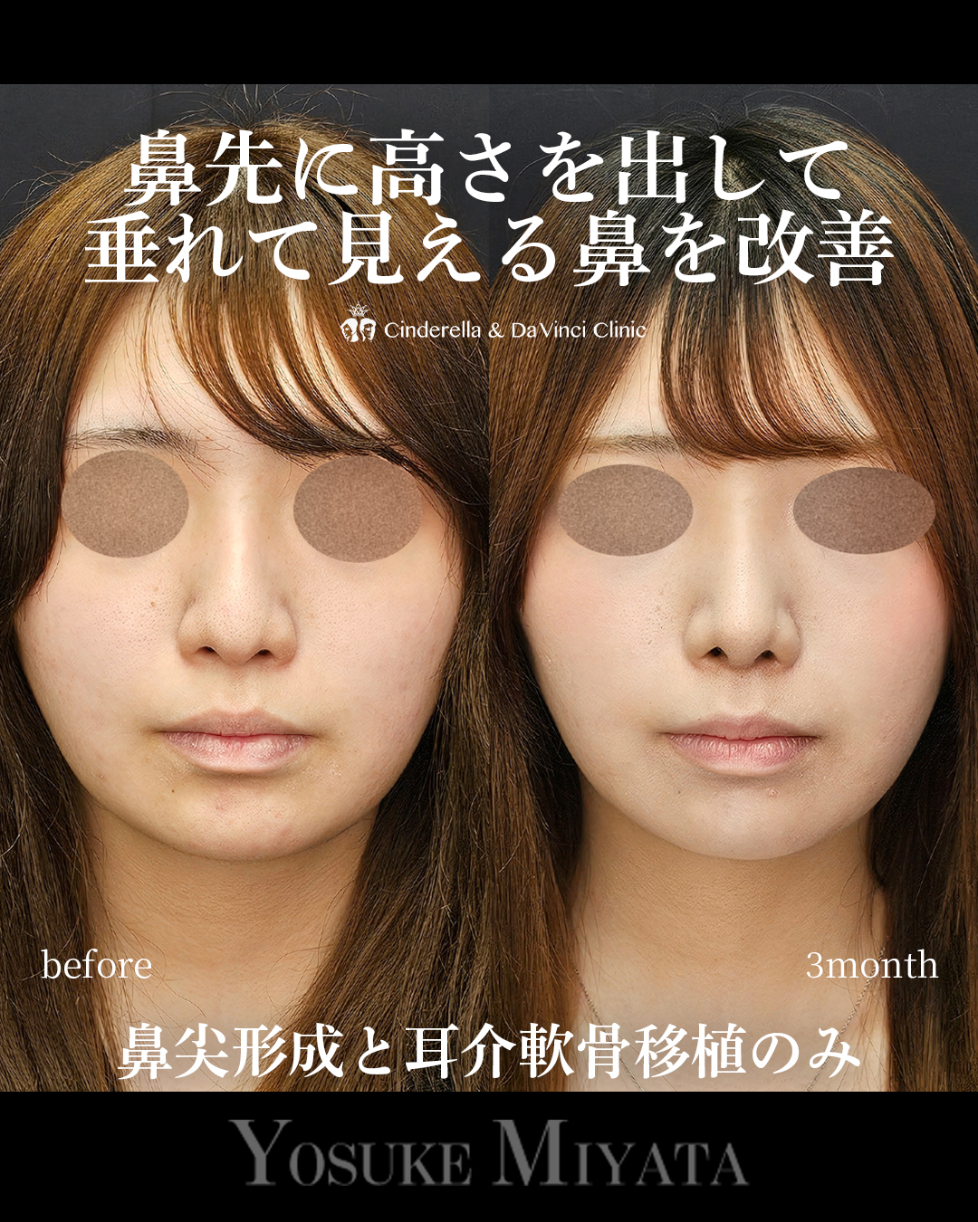 鼻先高く垂れ改善の画像