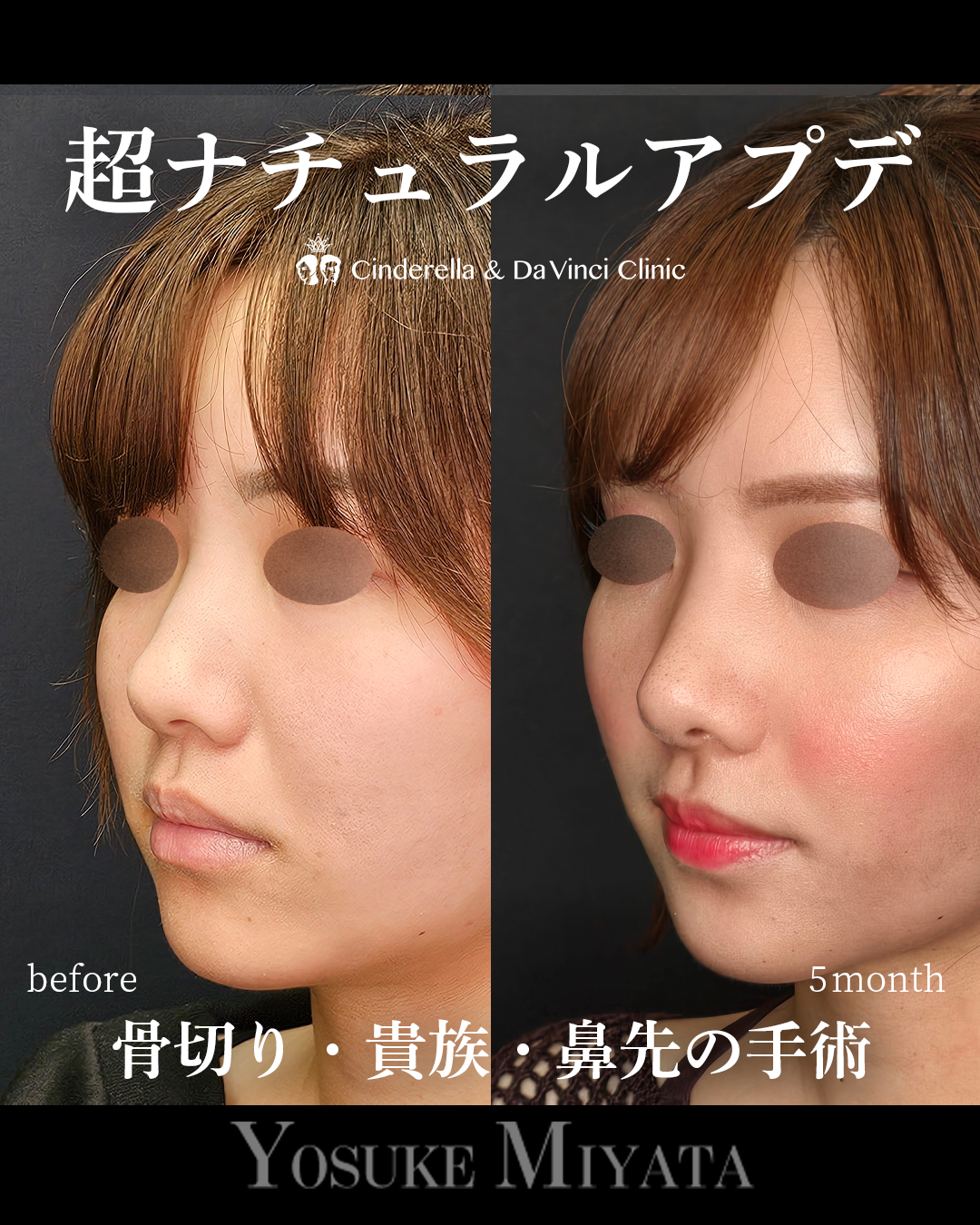 ナチュラルアプデの画像