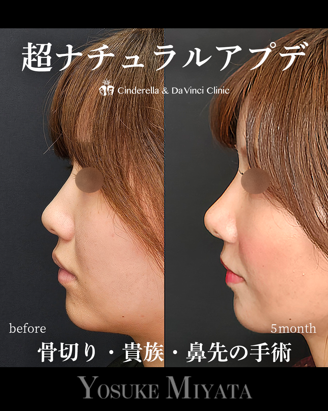 ナチュラルアプデの画像