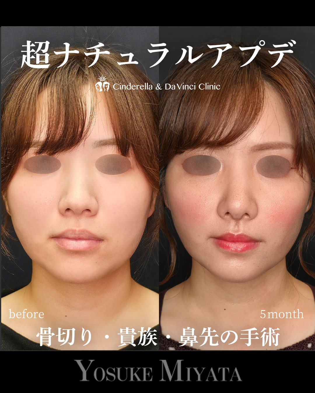 ナチュラルアプデの画像