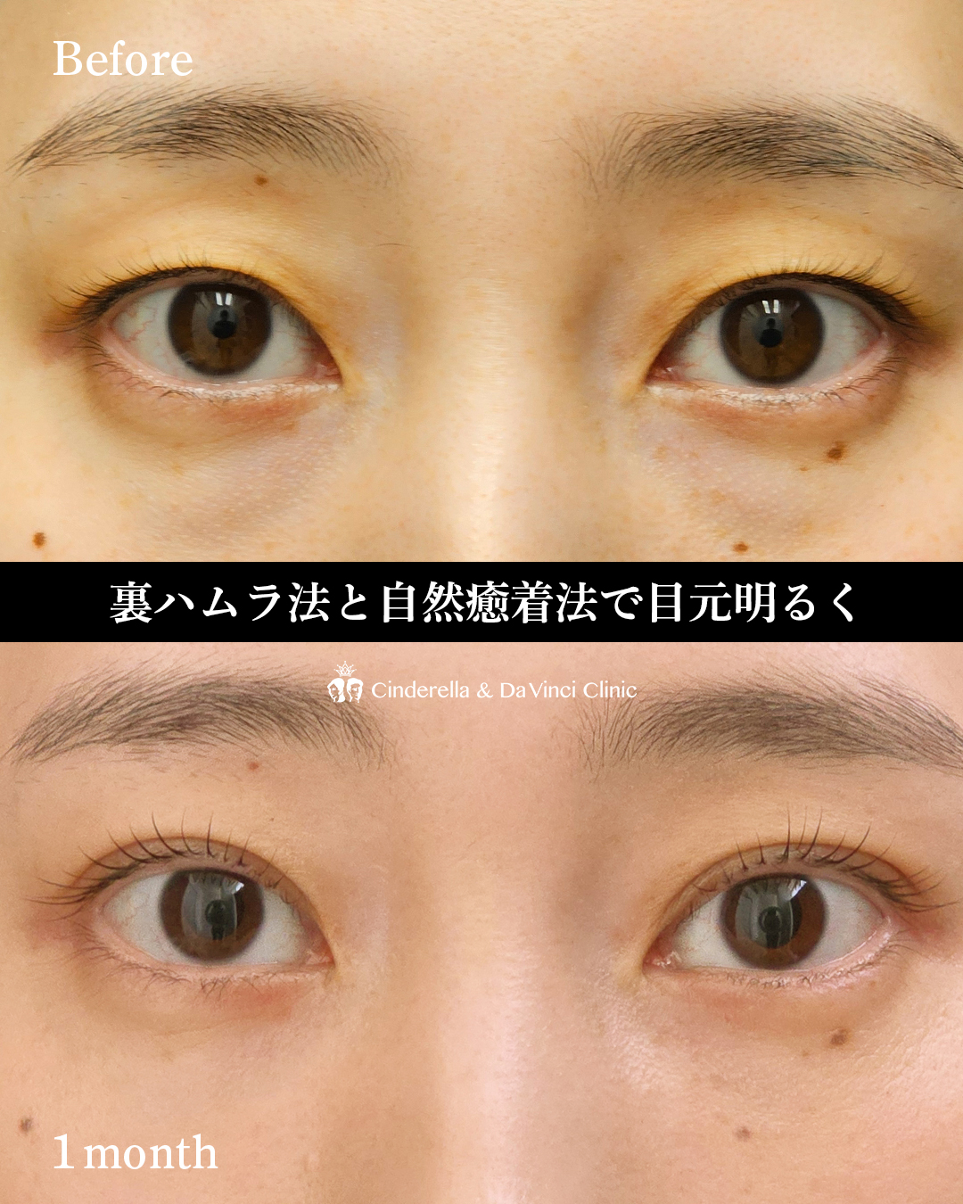 クマ取りと二重整形の画像