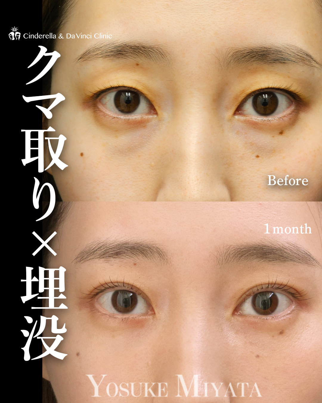 クマ取りと二重整形の画像