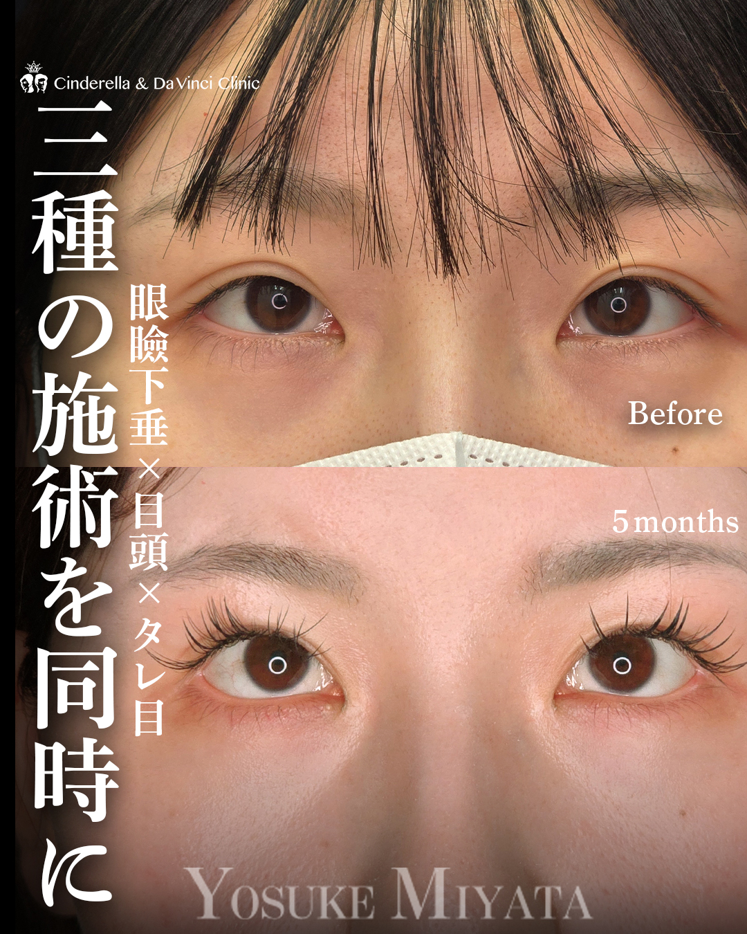 目の印象を変えるの画像