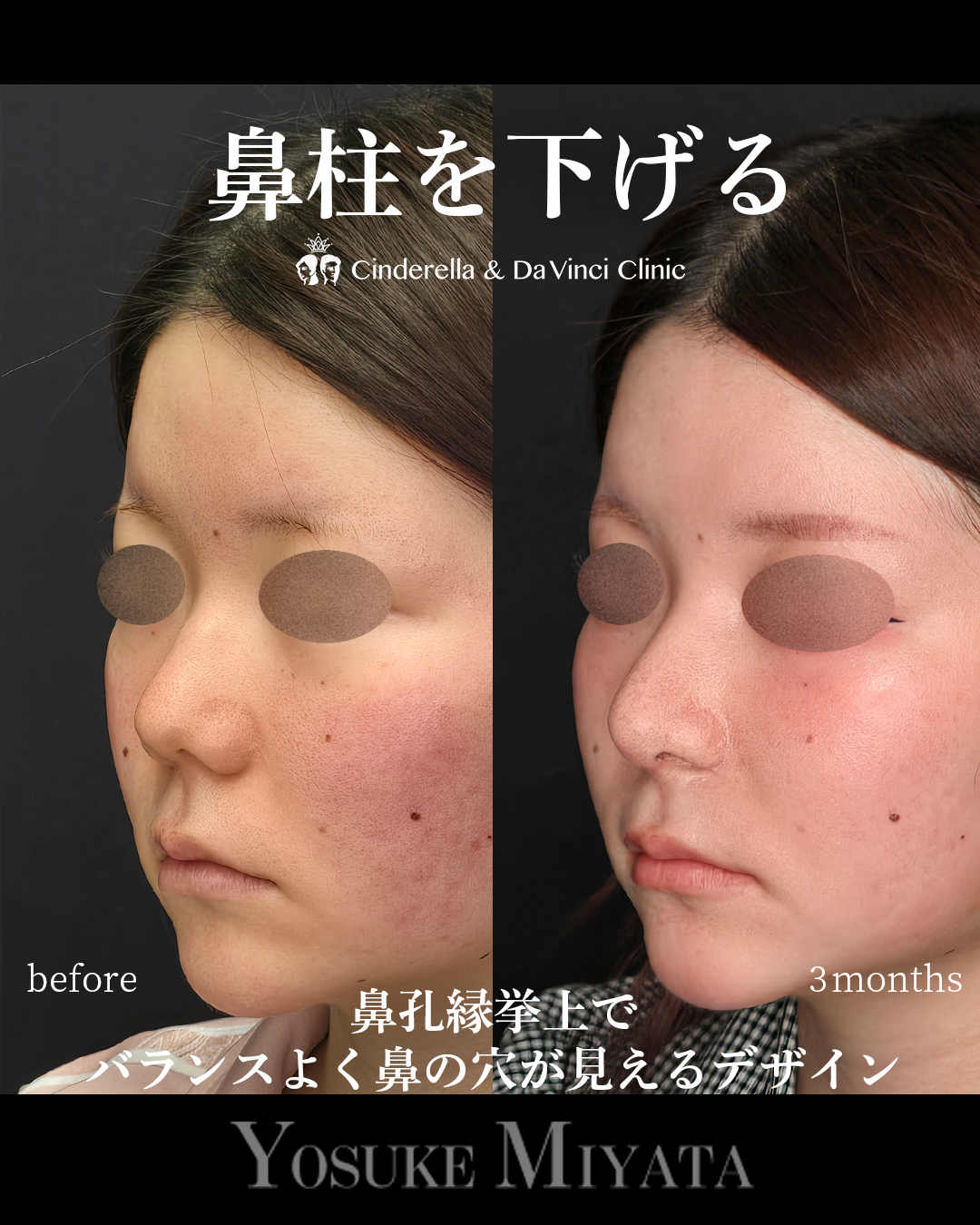 鼻柱を下げる鼻整形の画像
