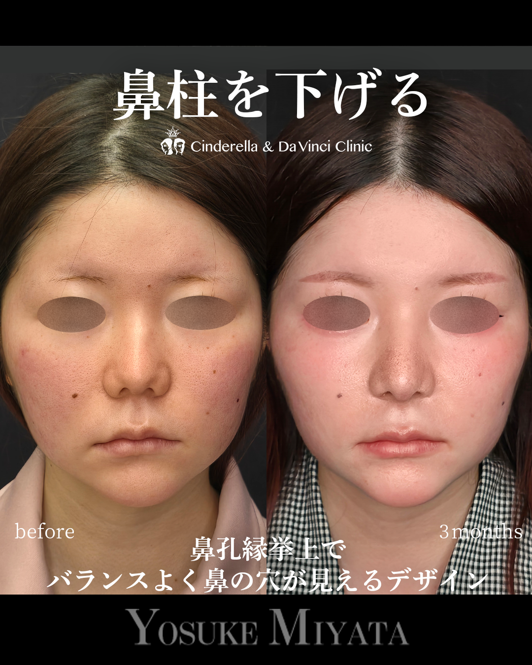 鼻柱を下げる鼻整形の画像