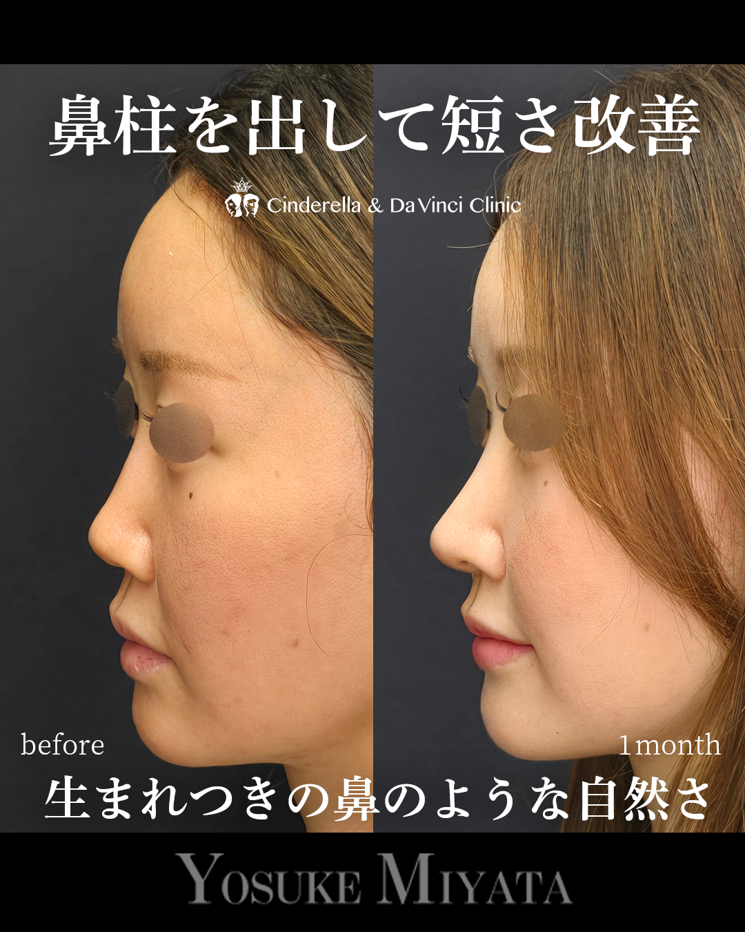 鼻柱を出し短鼻改善の画像