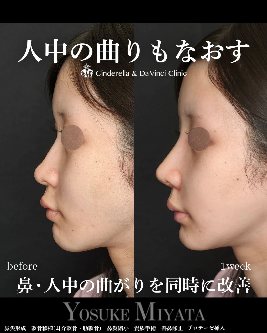 鼻と人中の歪み修正の画像