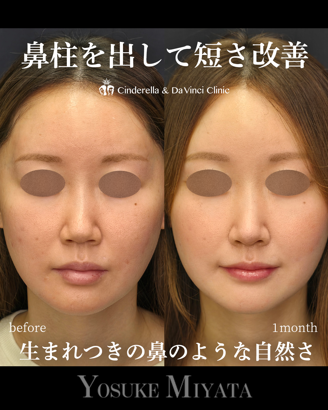 鼻柱を出し短鼻改善の画像