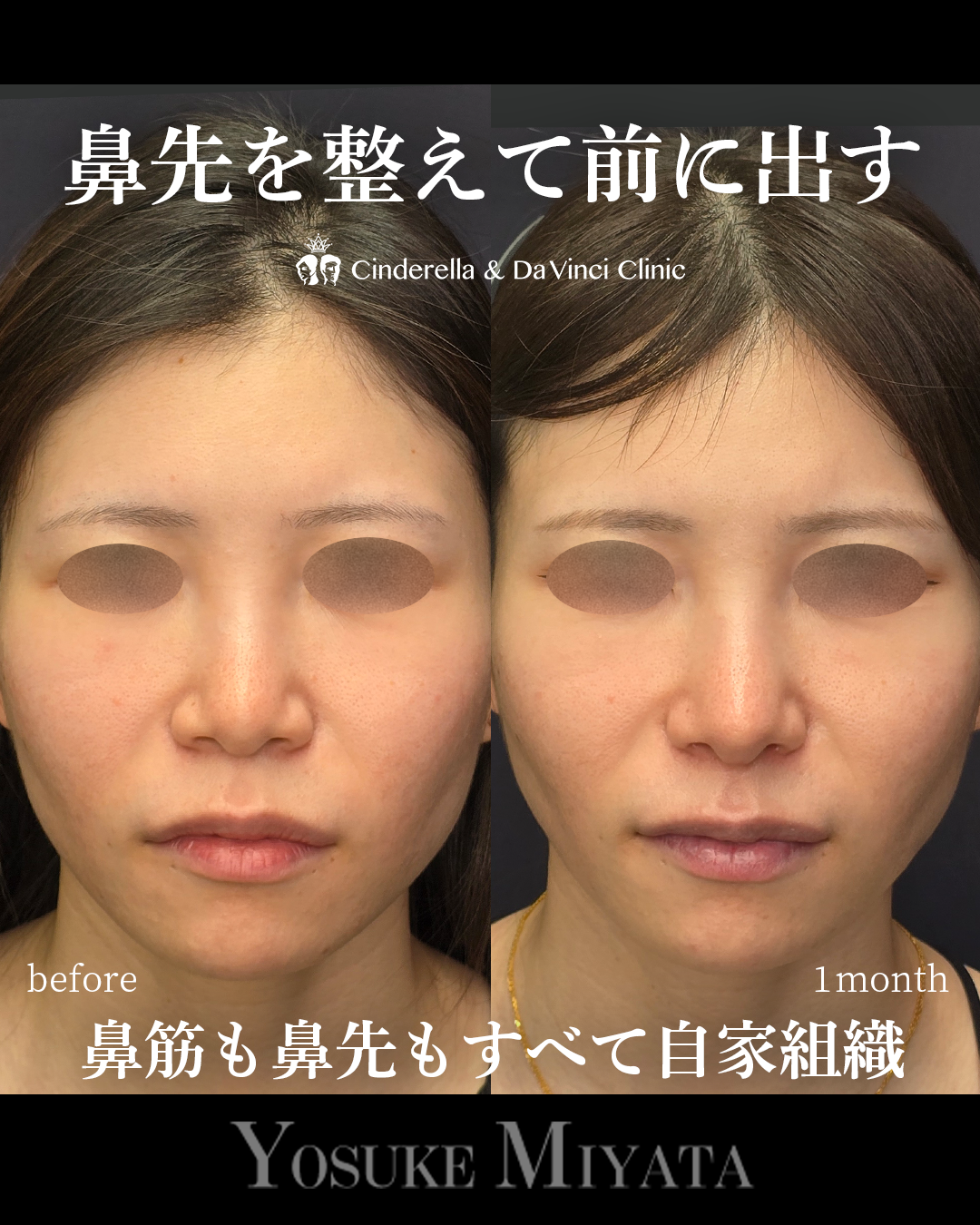 低くて丸い鼻先改善の画像