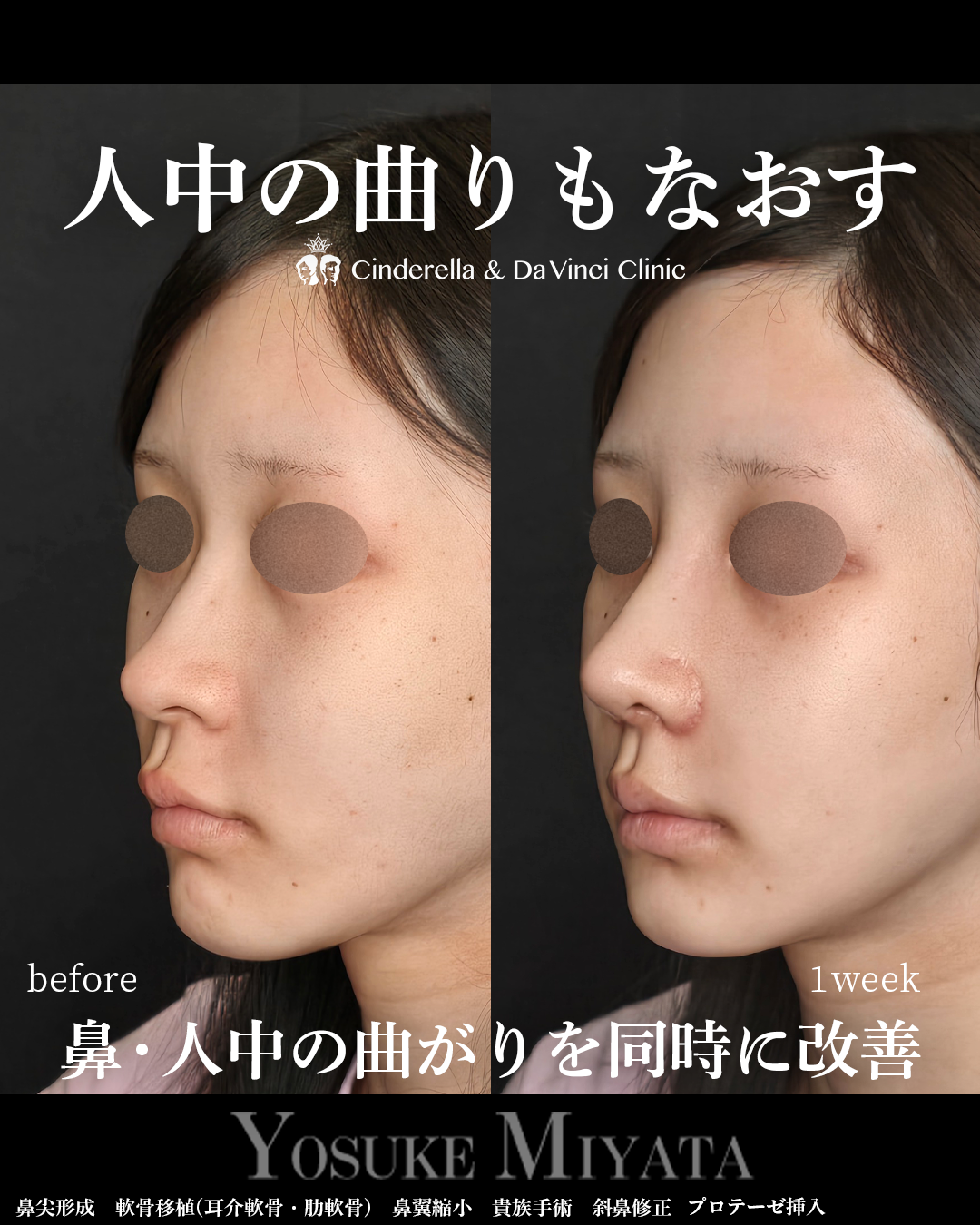 鼻と人中の歪み修正の画像