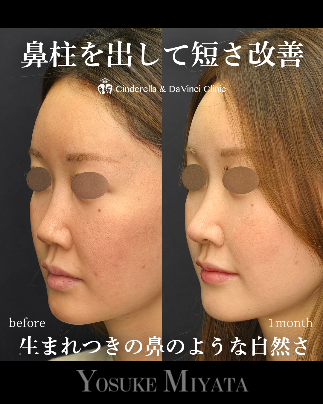 鼻柱を出し短鼻改善の画像