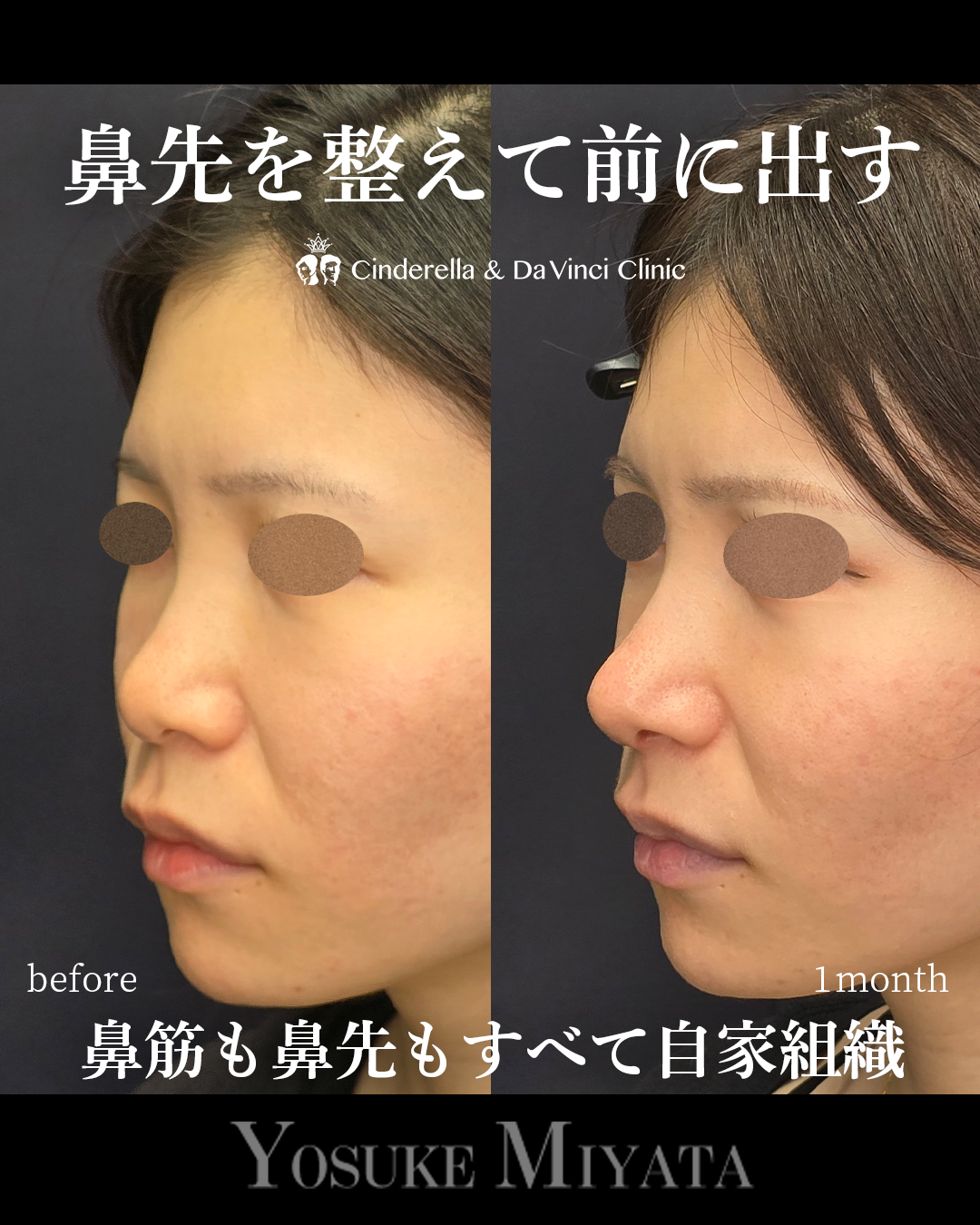低くて丸い鼻先改善の画像