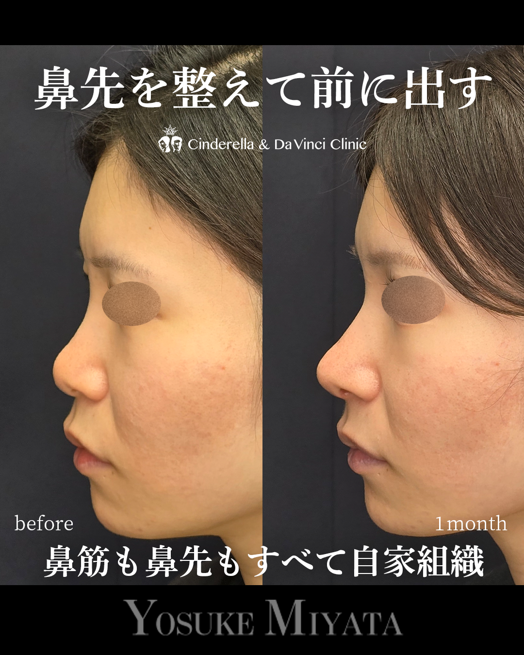 低くて丸い鼻先改善の画像