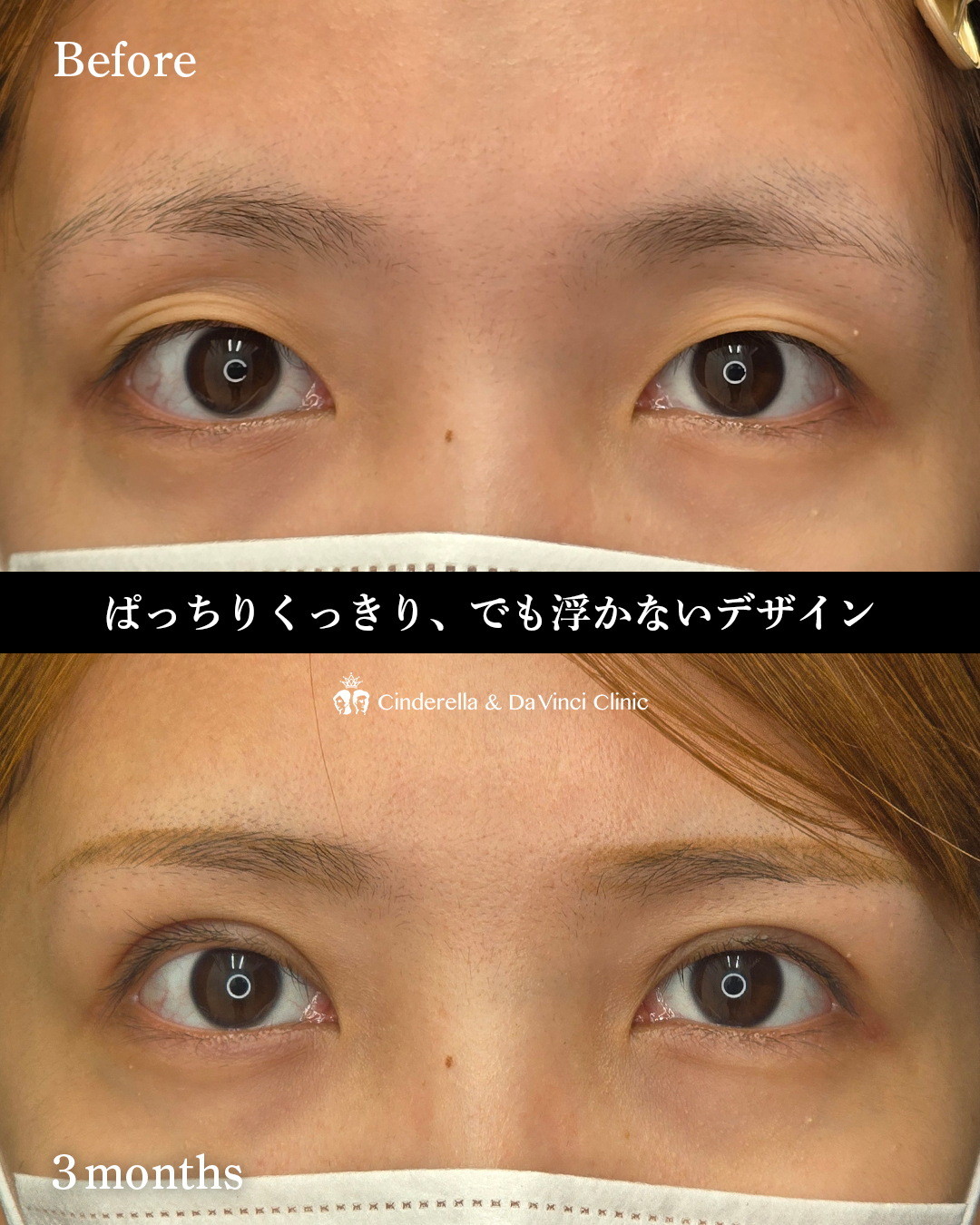 食い込み強め全切開の画像