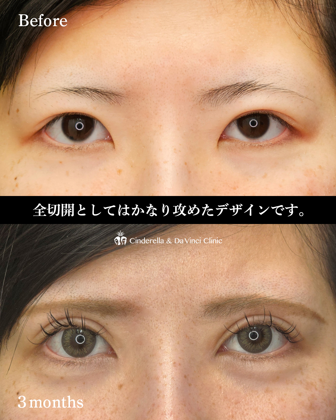 二重切開と目頭切開でハーフ顔の画像