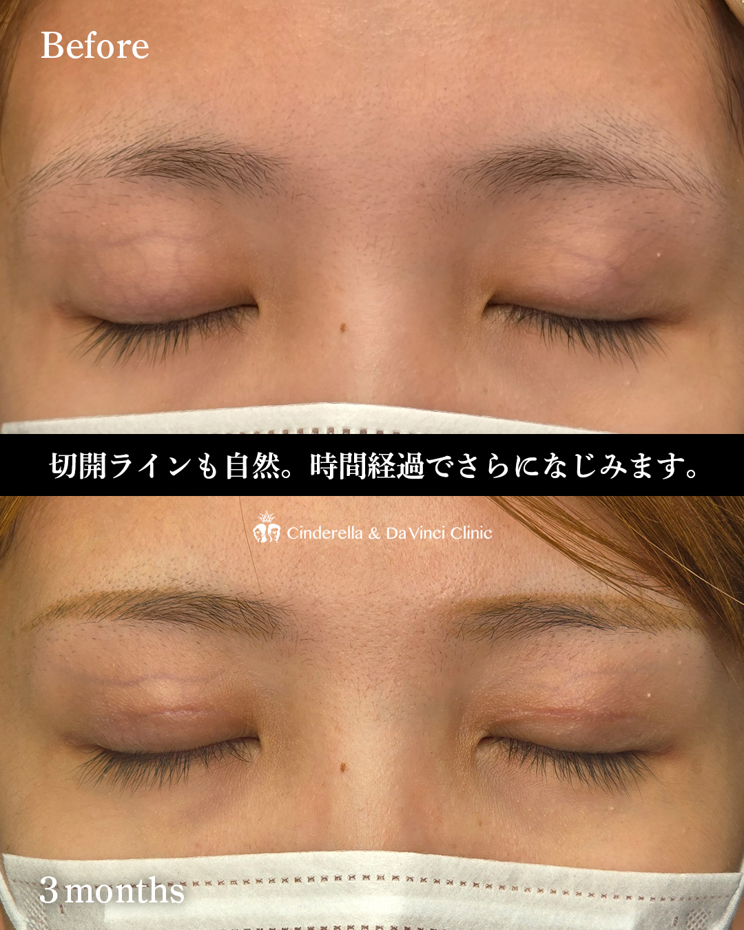 食い込み強め全切開の画像