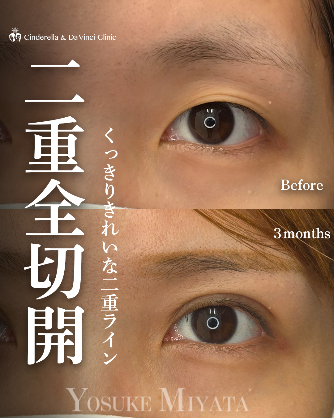 食い込み強め全切開の画像
