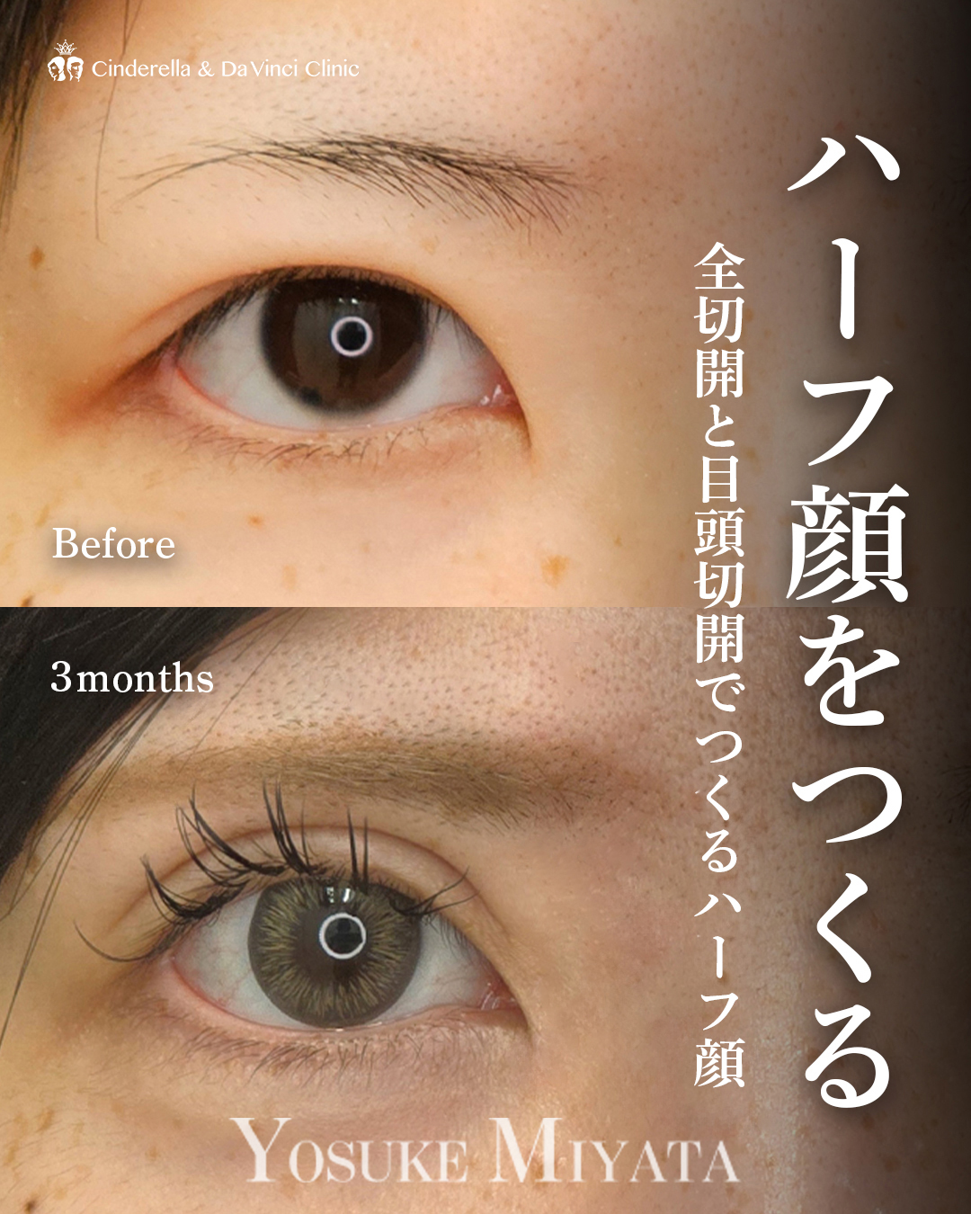二重切開と目頭切開でハーフ顔の画像