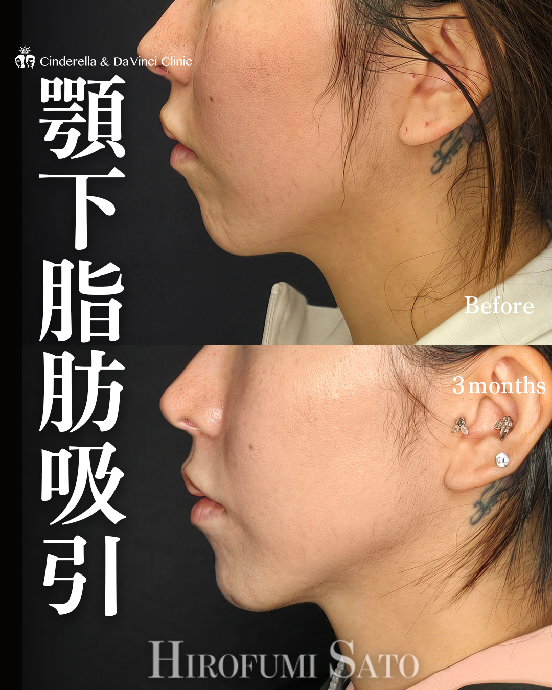 顎下の脂肪吸引のみの画像