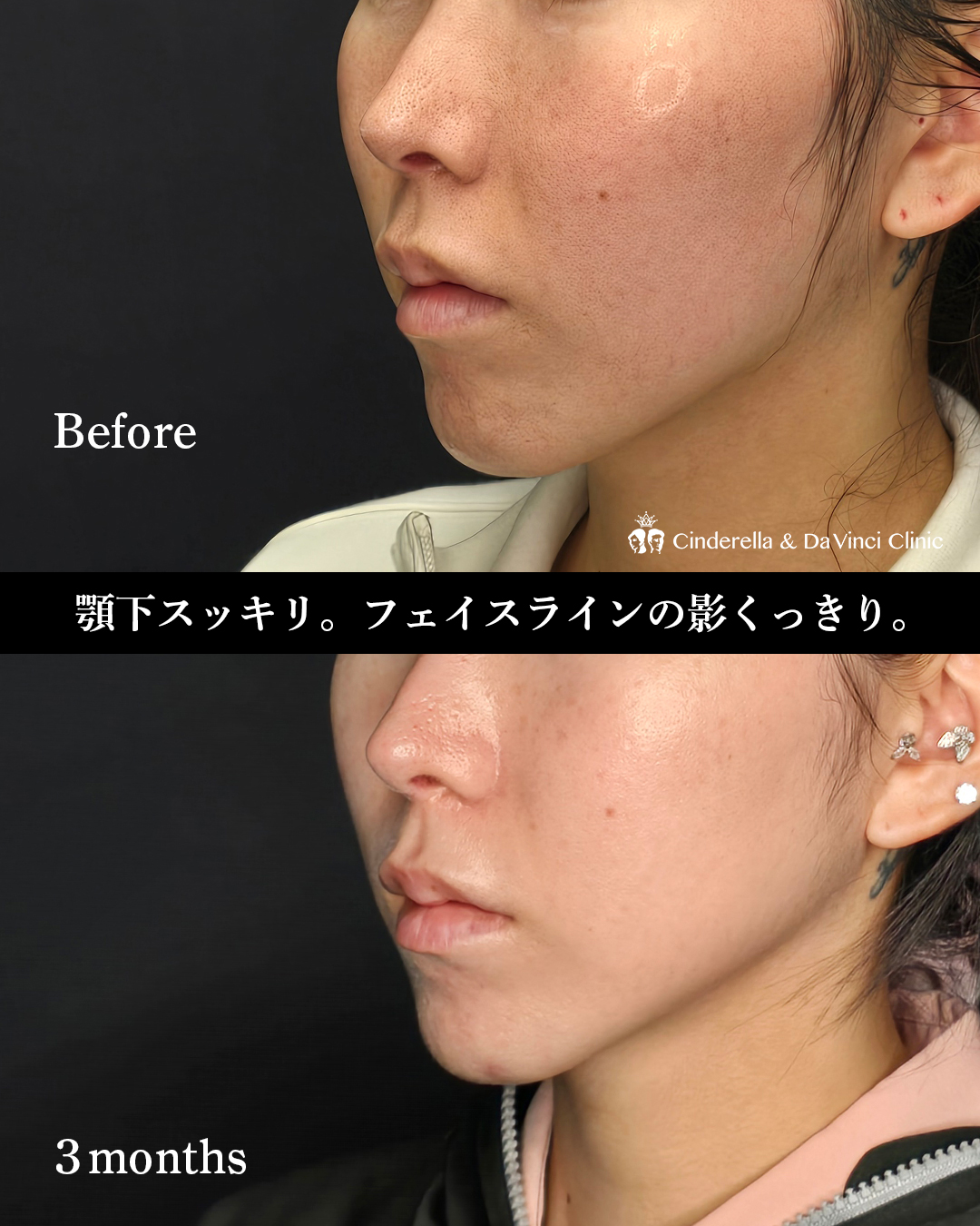 顎下の脂肪吸引のみの画像